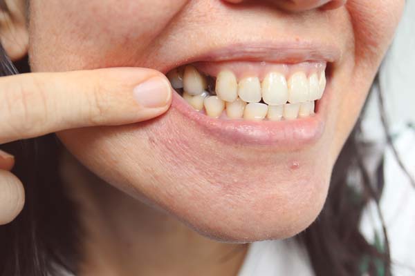 What Happens If You Do Not Replace Your Missing Teeth in Burlington, Ontario