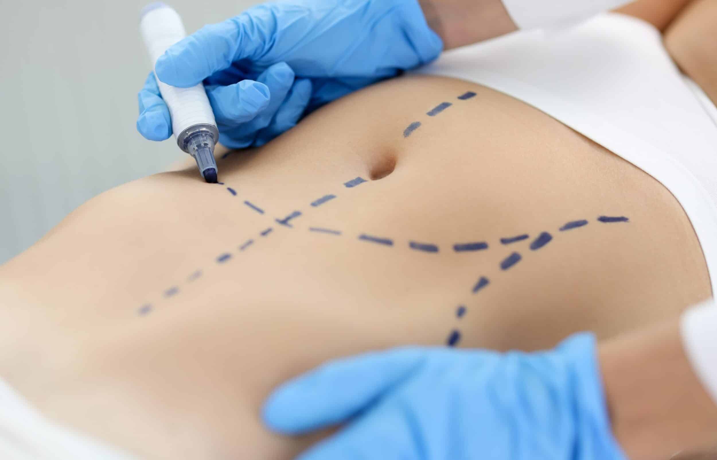 Lipo 360 and skin tightening- How they work together?